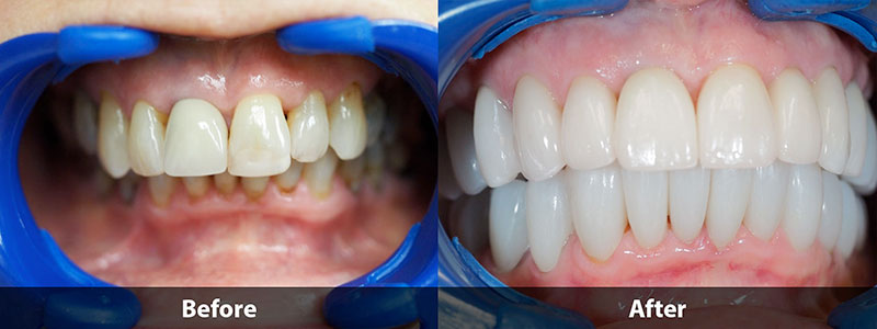 before & after difference of dental treatment