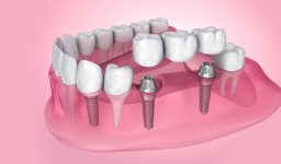 Types of Dental Bridges and the Procedure for Having Them