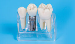What is Expected From Your Dental Implant Procedure in Leesburg