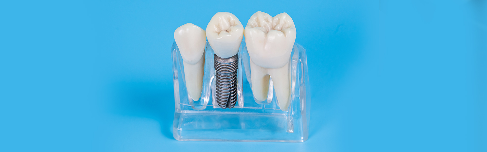 What is Expected From Your Dental Implant Procedure in Leesburg