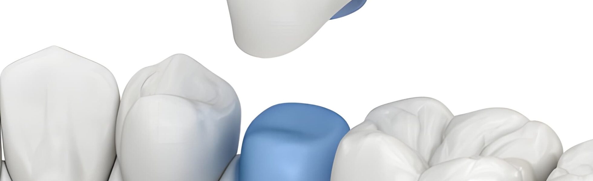 Dental Crowns in Leesburg, VA: Restore Your Smile with The Dental Co. of Leesburg